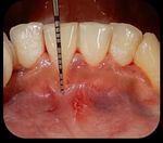 Surgical Root Coverage of Miller's Class I Gingival Recession Using Free Gingival Graft- A Case Report