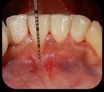Surgical Root Coverage of Miller's Class I Gingival Recession Using Free Gingival Graft- A Case Report
