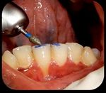 Surgical Root Coverage of Miller's Class I Gingival Recession Using Free Gingival Graft- A Case Report