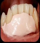 Surgical Root Coverage of Miller's Class I Gingival Recession Using Free Gingival Graft- A Case Report
