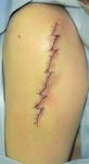 The Latest Strategy for Keloid and Hypertrophic Scar Prevention and Treatment: The Nippon Medical School (NMS) Protocol - J-Stage