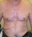 The Latest Strategy for Keloid and Hypertrophic Scar Prevention and Treatment: The Nippon Medical School (NMS) Protocol - J-Stage