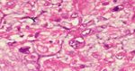 Unusual Presentation of a Metastatic Lymph Node from Giant Phyllodes Tumour of Breast- A Case Report