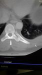 Osteoid osteoma of the ribs-Is image intensifier or bone scintigraphy a mandatory diagnostic tool-A case report with Review of literature - OAText