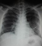 Osteoid osteoma of the ribs-Is image intensifier or bone scintigraphy a mandatory diagnostic tool-A case report with Review of literature - OAText