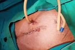 Modified gastrostomy feeding tubes in patients with oesophageal cancer: our experience from Northern Tanzania