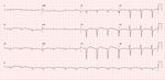 Statement Position Statement on Diagnosis and Treatment of Cardiac Amyloidosis 2021 - ABC Cardiol
