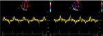 Statement Position Statement on Diagnosis and Treatment of Cardiac Amyloidosis 2021 - ABC Cardiol