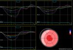 Statement Position Statement on Diagnosis and Treatment of Cardiac Amyloidosis 2021 - ABC Cardiol