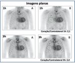 Statement Position Statement on Diagnosis and Treatment of Cardiac Amyloidosis 2021 - ABC Cardiol