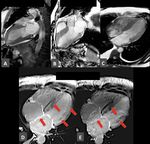 Statement Position Statement on Diagnosis and Treatment of Cardiac Amyloidosis 2021 - ABC Cardiol