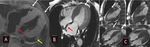 Statement Position Statement on Diagnosis and Treatment of Cardiac Amyloidosis 2021 - ABC Cardiol