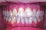 Sustainable Smile using the Invisalign Go System with Non-Invasive Treatment Approach - Invisalign Go Case Report