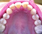 Sustainable Smile using the Invisalign Go System with Non-Invasive Treatment Approach - Invisalign Go Case Report