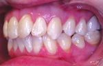 Sustainable Smile using the Invisalign Go System with Non-Invasive Treatment Approach - Invisalign Go Case Report