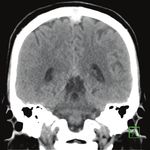 Cerebral venous thrombosis: a spectrum of imaging findings