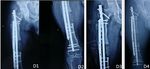 Refractory chronic osteomyelitis of femur: A case report - Open ...