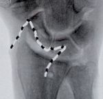 Arthroscopy Reconstruction Surgery for Chronic Scapholunate Injury with ILA - Internal Ligament Augmentation - GMReis