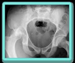 Essentials of Emergency Radiology 2018: Pearls & Pitfalls June 9-10, 2018 - Mass General Hospital